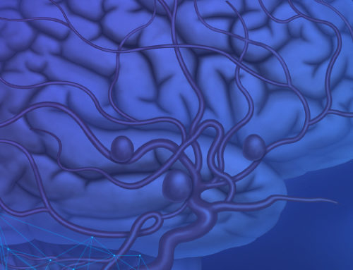 Aneurisma cerebral: riscos de ruptura e tratamento